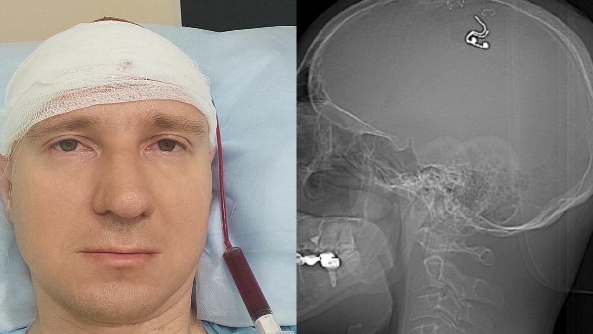 "Сам себе нейрохирург": новосибирский блогер просверлил себе череп дрелью во имя науки