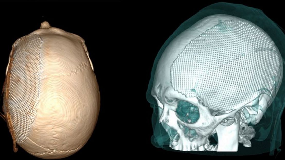 Свердловские врачи восстановили пациенту кости черепа при помощи 3D-моделирования